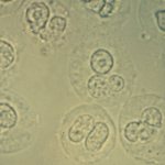 белок и лейкоциты в моче