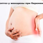 Нефроптоз у женщин при беременности