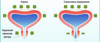 Стрессовое недержание мочи